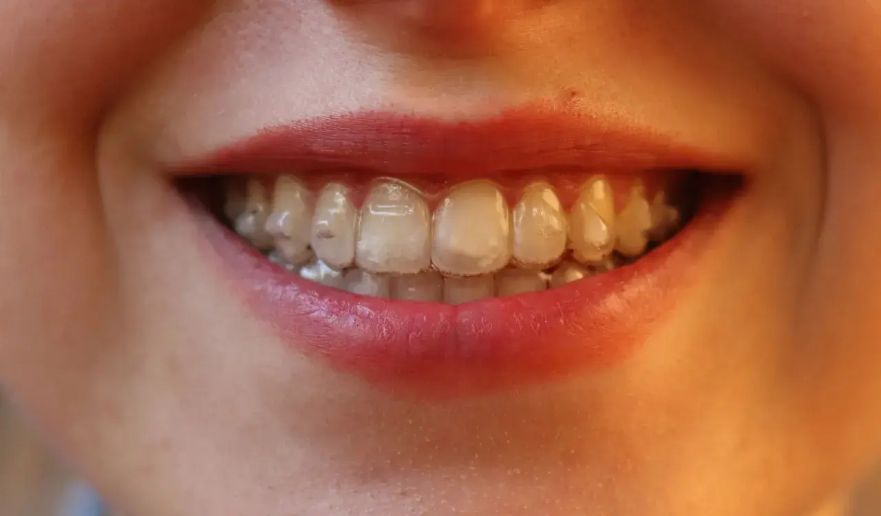 Sonrisa con alineadores transparentes, buscando blanquear Invisalign para una sonrisa radiante.