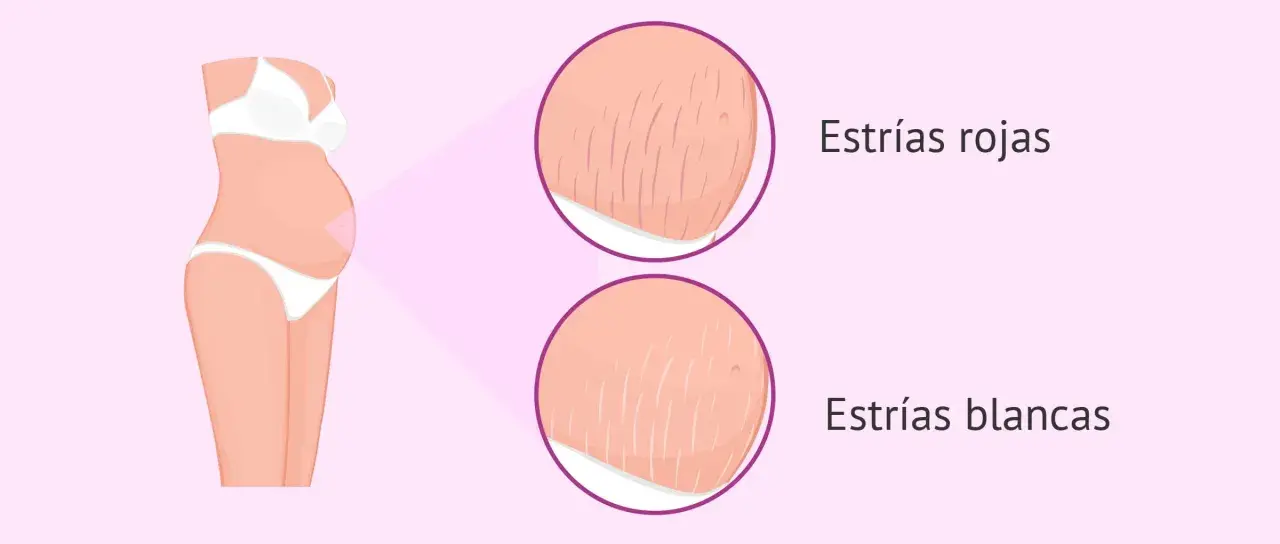 Ilustración de abdomen de embarazada mostrando estrías rojas y blancas, marcas comunes del embarazo.