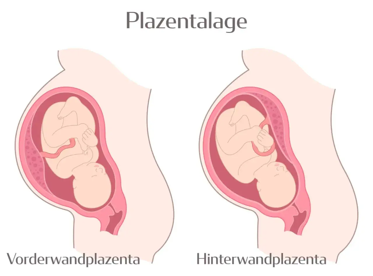 Zwei Darstellungen einer Schwangerschaft: Links eine vorderwand plazenta, rechts eine hinterwandplazenta. Der Fötus ist in beiden Fällen gut erkennbar.