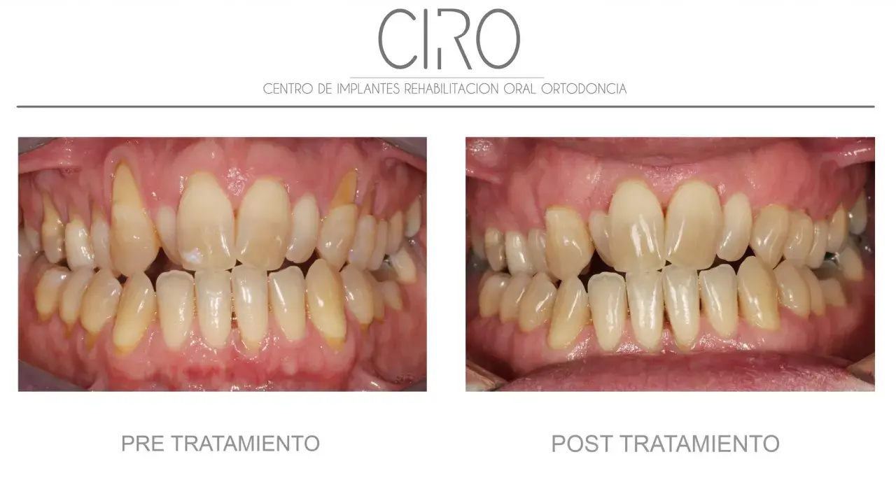 Comparación antes y después de un tratamiento de mantenimiento periodontal. Dientes amarillentos y encías inflamadas antes, y dientes limpios y encías sanas después.