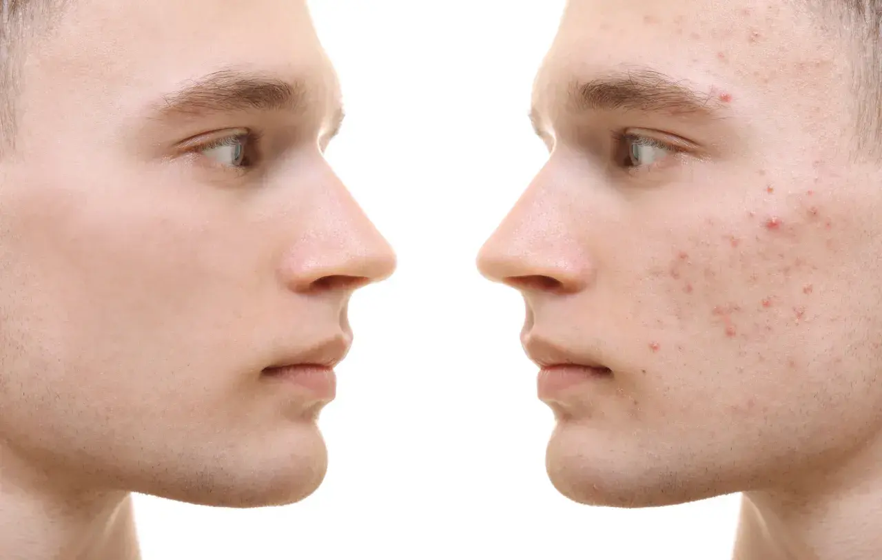 Gesichtsprofil links: reine Haut. Rechts: Akne-Ausbrüche, die durch Omega-3-Fettsäuren verbessert werden könnten.