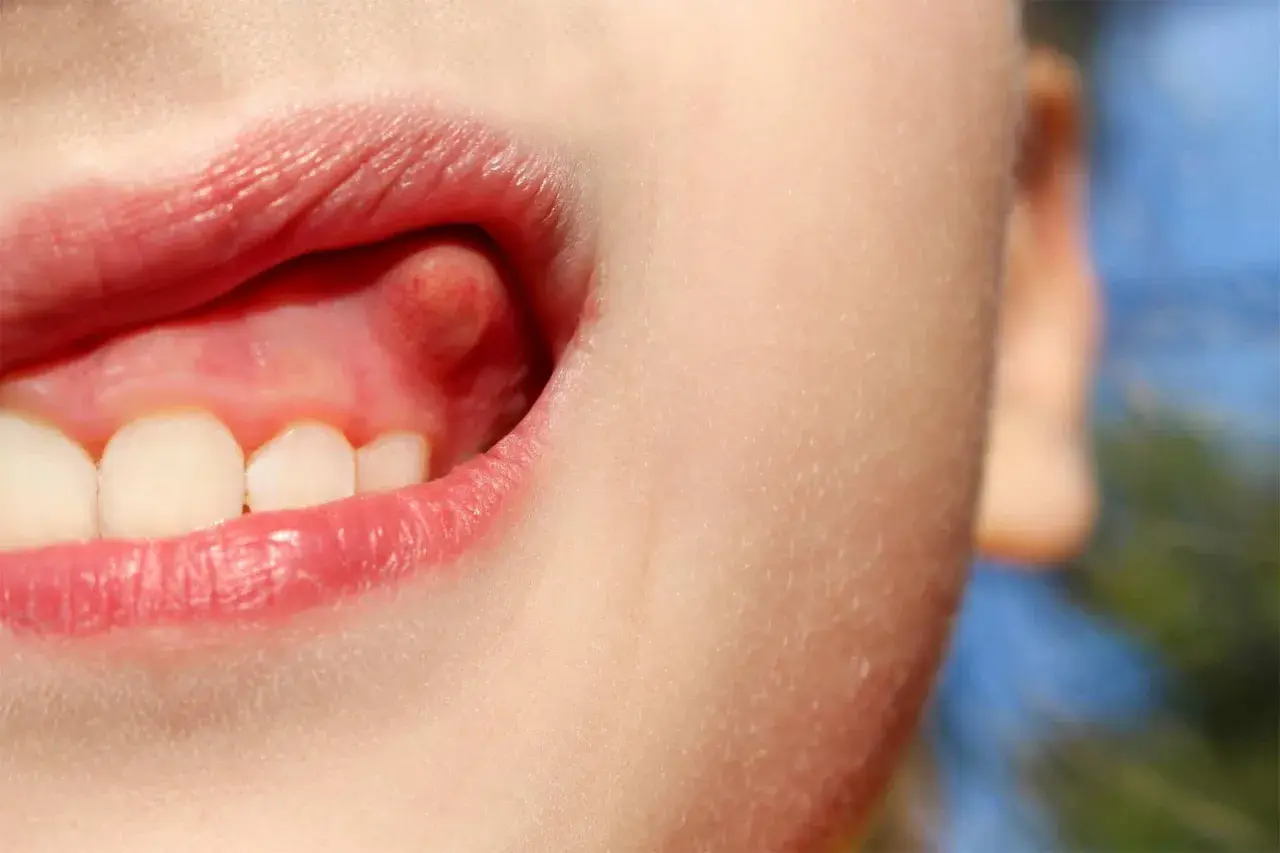 Primer plano de una boca infantil mostrando un bulto en la encía, cerca de los dientes frontales.