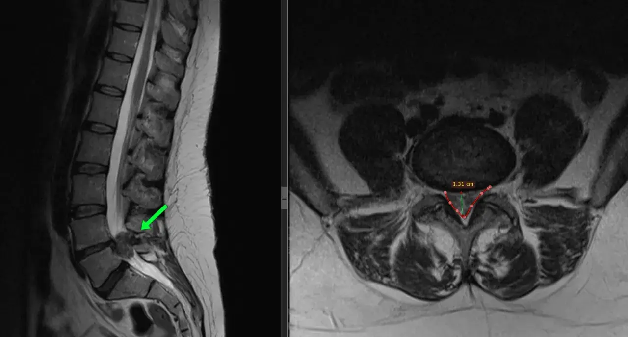MRI kręgosłupa lędźwiowego z widoczną przepukliną krążka międzykręgowego, zaznaczoną zieloną strzałką. Widoczny pomiar 1.31 cm.