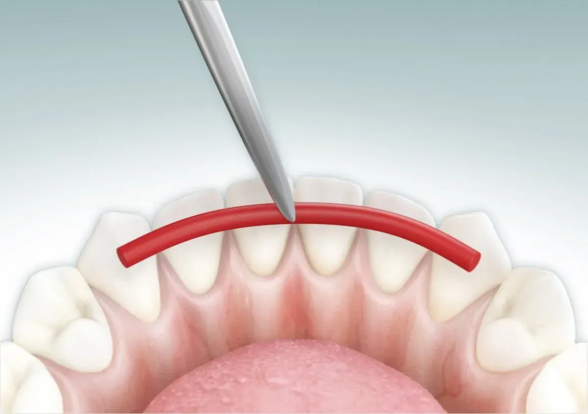 Strumento dentale applica filo rosso per splintaggio denti inferiori, facilitando la pulizia.