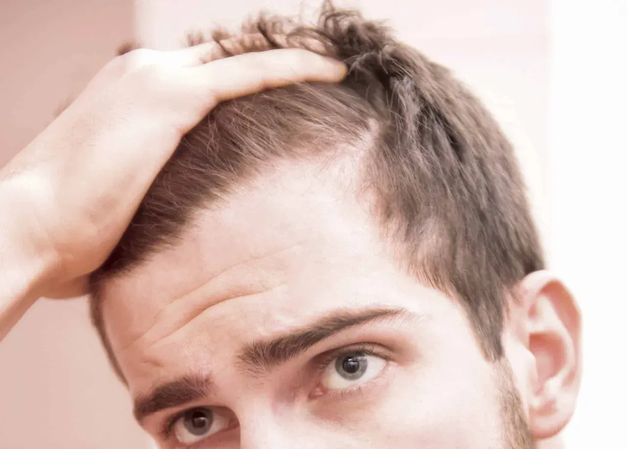 Hombre preocupado por el efluvio telógeno, tocando su cabeza. Considera usar minoxidil para recuperar su cabello.