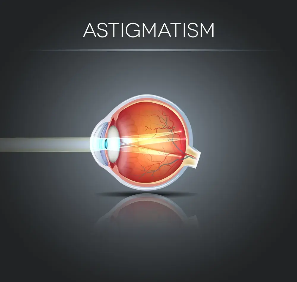 Astygmatyzm: Okulista czy Optometrysta? Sprawdź, kogo wybrać!