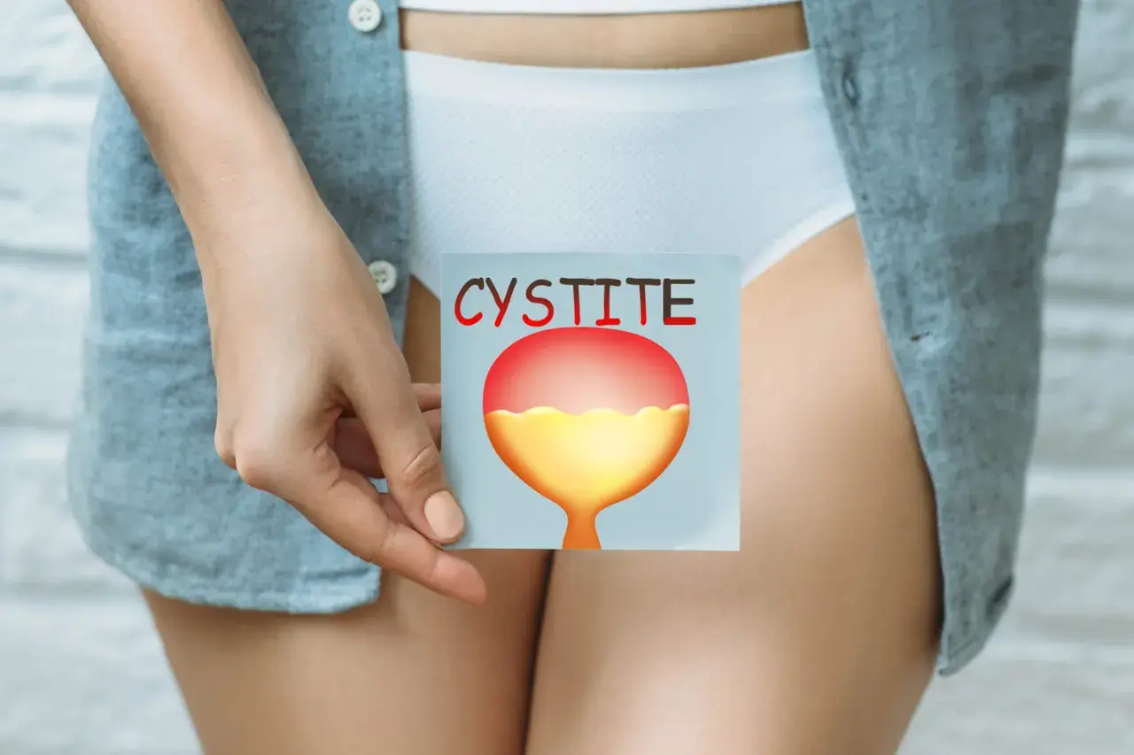 Une main tient une carte illustrant une vessie enflammée, avec le mot "CYSTITE" écrit en rouge. Cela peut aider à comprendre comment attraper une infection urinaire.