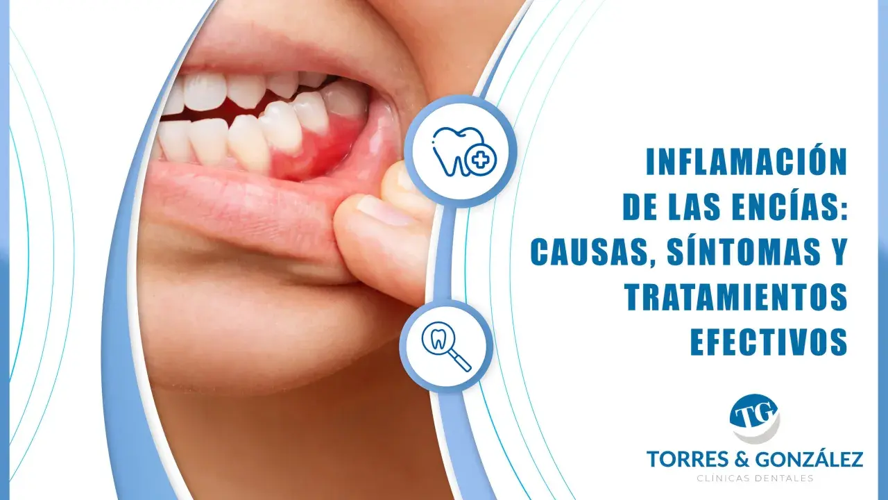 Primer plano de encías inflamadas, mostrando los síntomas de la gingivitis. Información sobre causas y tratamientos.