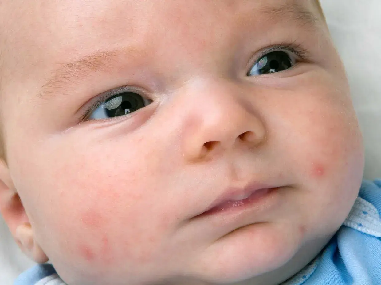 Primo piano del viso di un neonato con lievi arrossamenti e qualche piccolo brufolo, tipici dell'acne neonatale.
