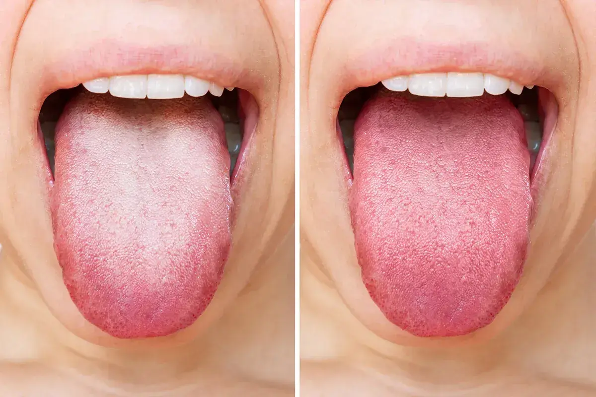 Comparación de lenguas: una muestra la suciedad en la lengua, la otra muestra una lengua limpia y rosada.