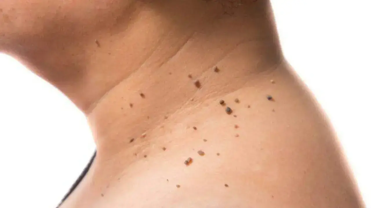 Primer plano de la piel del cuello mostrando varios tipos de manchas, incluyendo lunares y verrugas.
