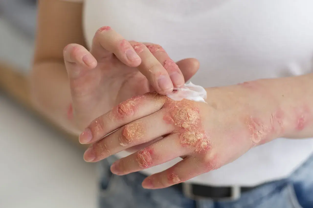 Manos con psoriasis, aplicando crema para aliviar la piel seca y escamosa.