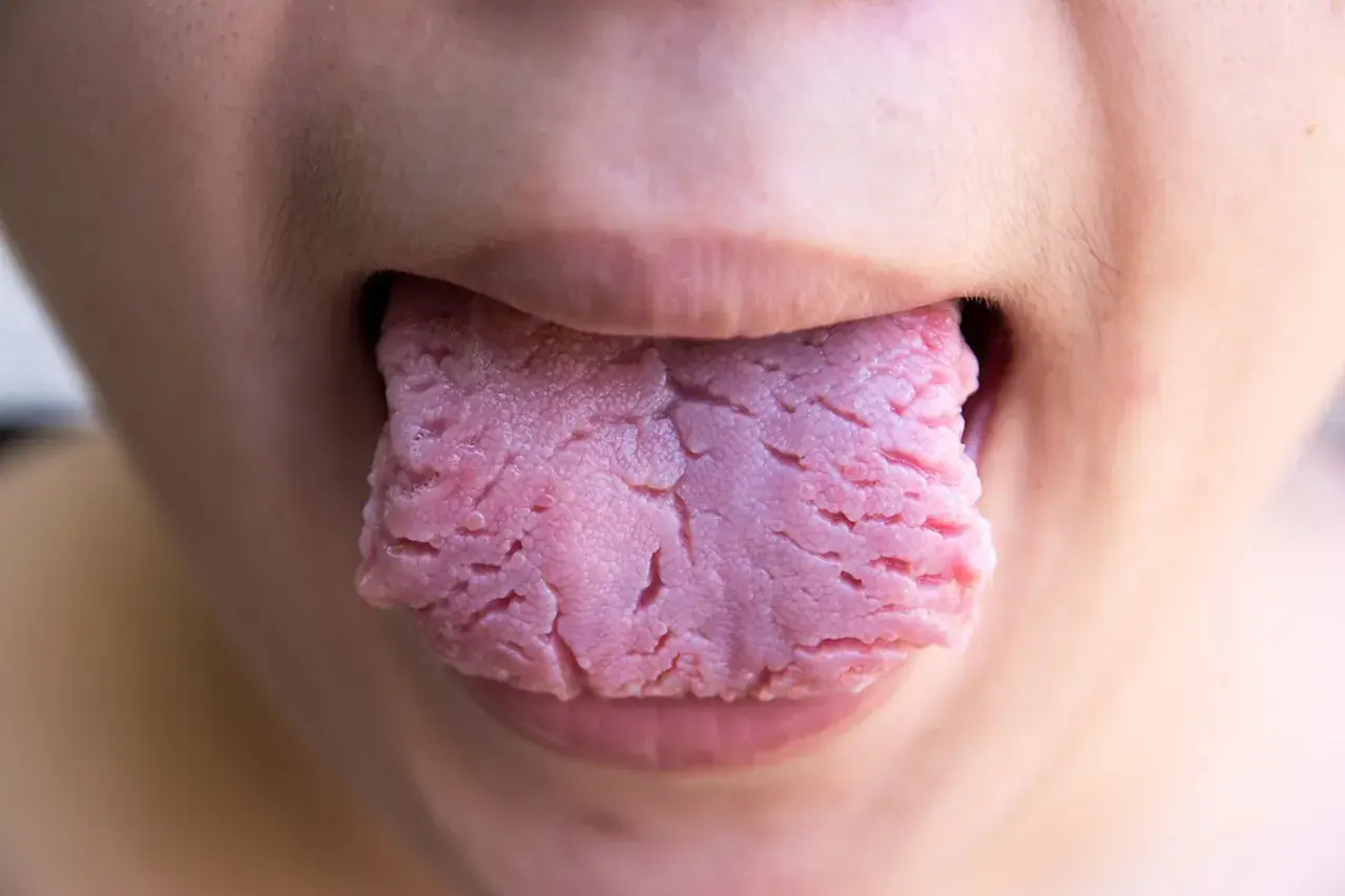 Primer plano de una lengua roja con surcos profundos, asomando entre los labios.