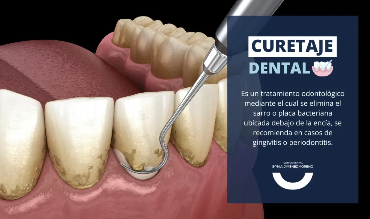 Instrumento dental elimina sarro bajo la encía, esencial para la limpieza periodontal y prevenir la periodontitis.