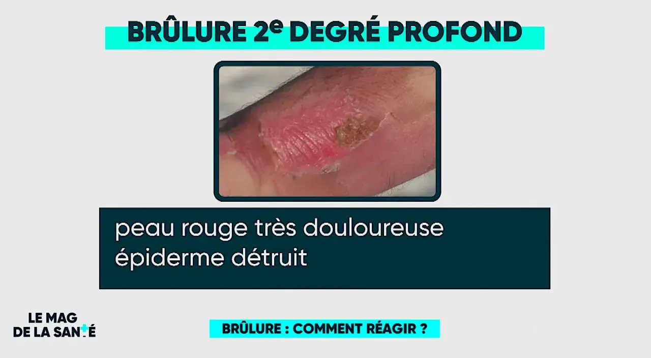 Brûlure 2e degré profond sur la main, peau rouge et douloureuse, épiderme détruit. Une brûlure eau bouillante degré.