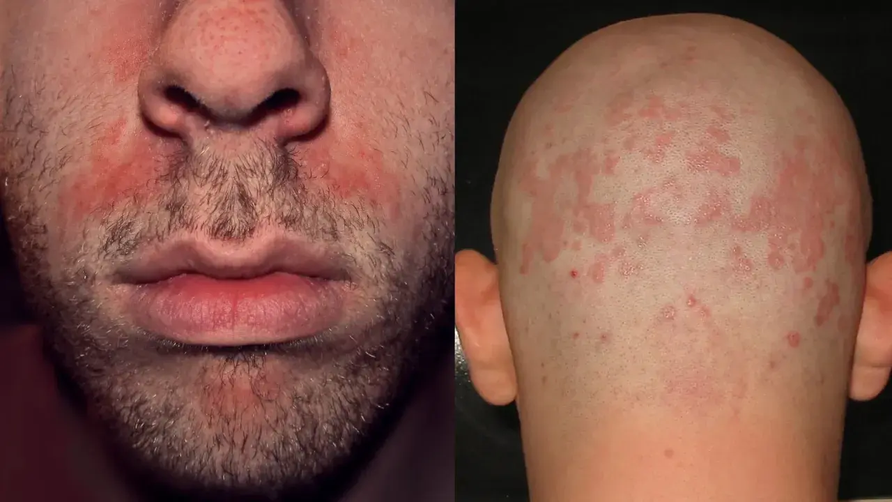 Viso e cuoio capelluto con arrossamenti e squame, segni tipici della dermatite seborroica.