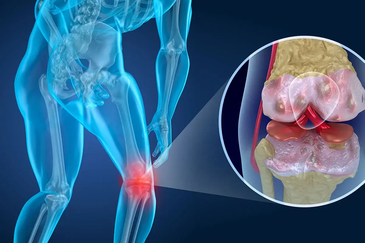 Menschliches Knie mit entzündetem Gelenk. Nahaufnahme zeigt abgenutzten Knorpel, der den Aufbau von Knorpel verdeutlicht.