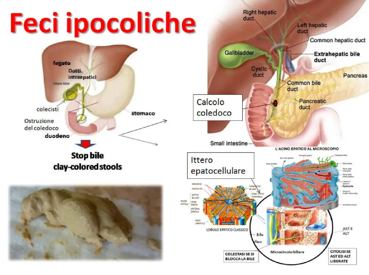 Feci ipocoliche, color argilla, dovute a ostruzione biliare. L'immagine mostra un diagramma del sistema biliare e un esempio di feci chiare.