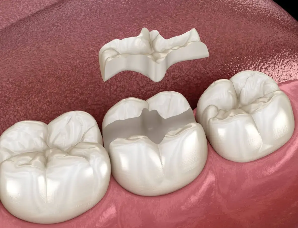 Una incrustación cerámica dental lista para ser colocada en un molar.