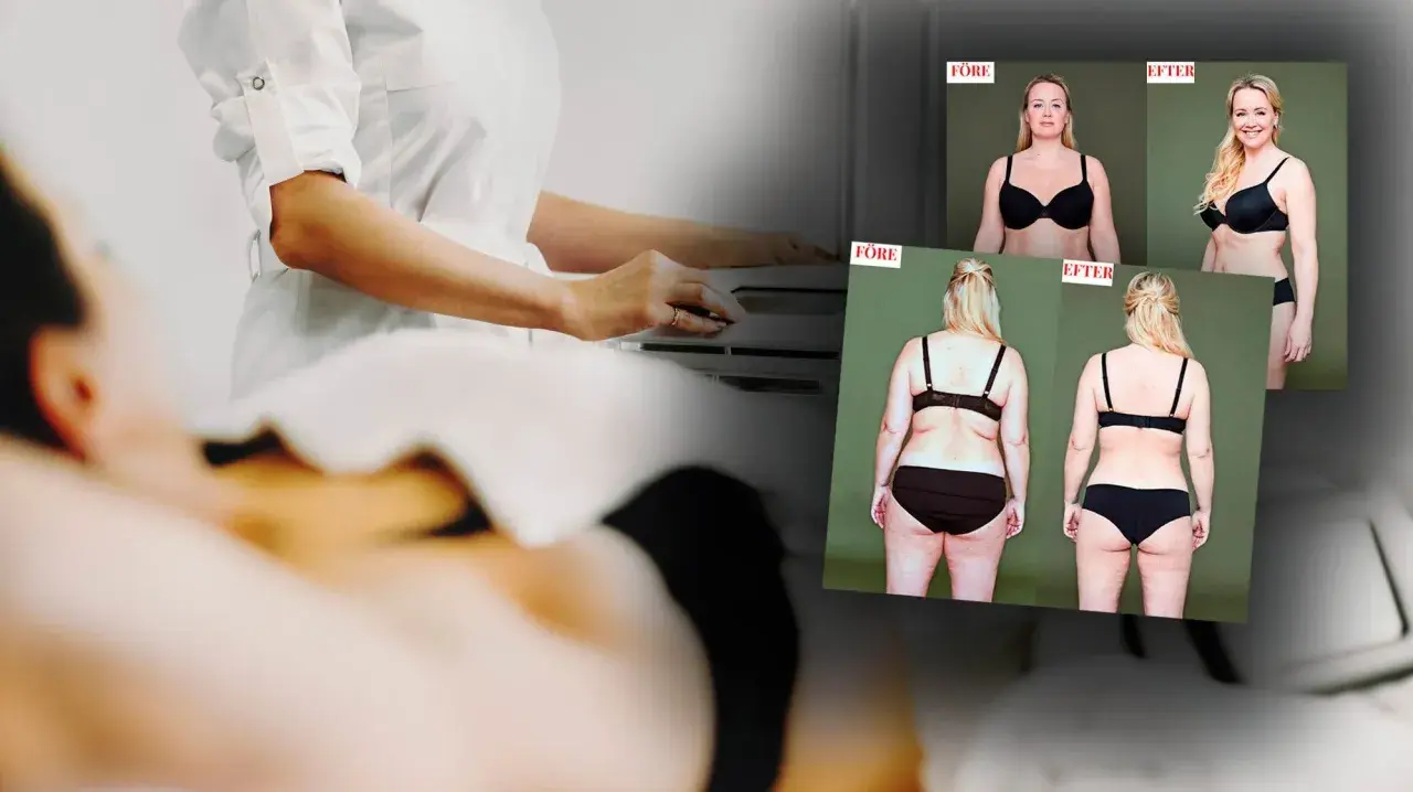 Före- och efterbilder visar resultat av coolsculpting armar. En person i vit rock utför behandling.
