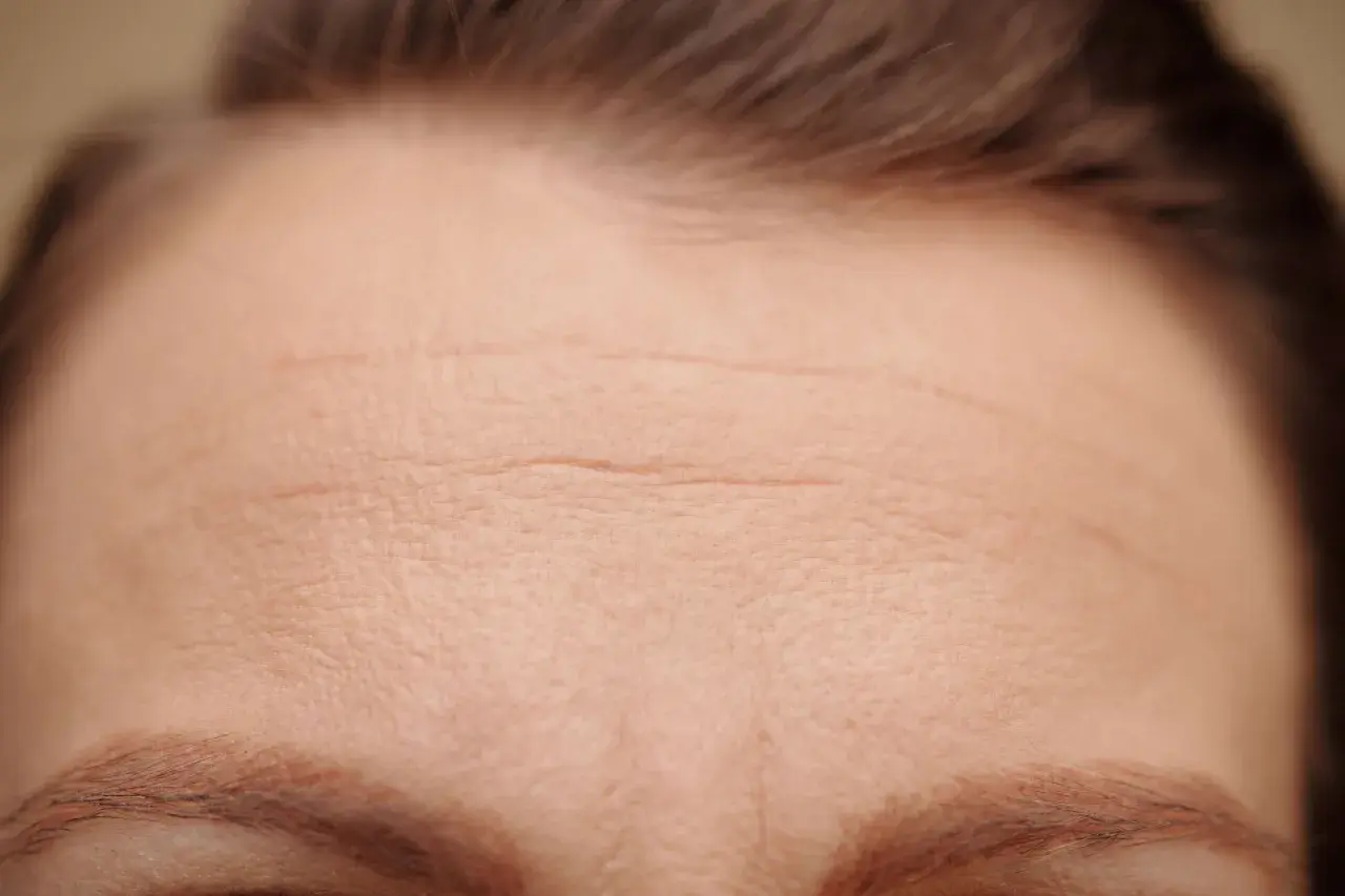 Close-up of a forehead with visible horizontal wrinkles and eyebrows.