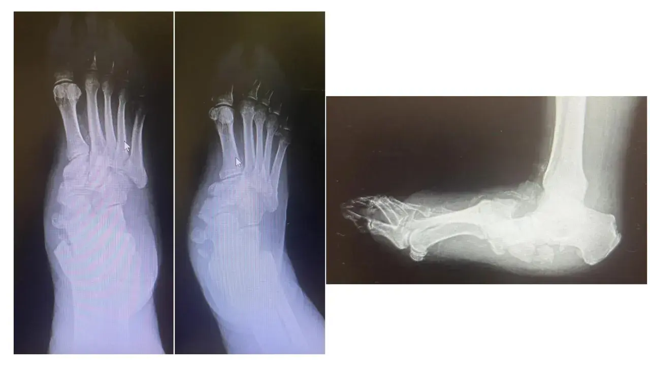 Radiografie del piede con deformità tipica del piede di Charcot, in preparazione per un intervento chirurgico.