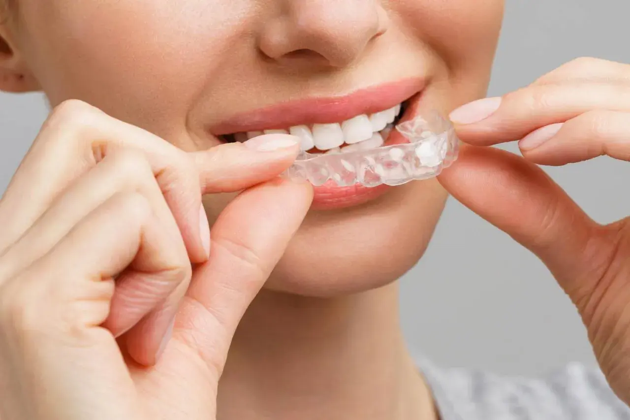 Sorriso smagliante con clear aligners. La donna sorride mentre applica gli apparecchi trasparenti per un sorriso perfetto.