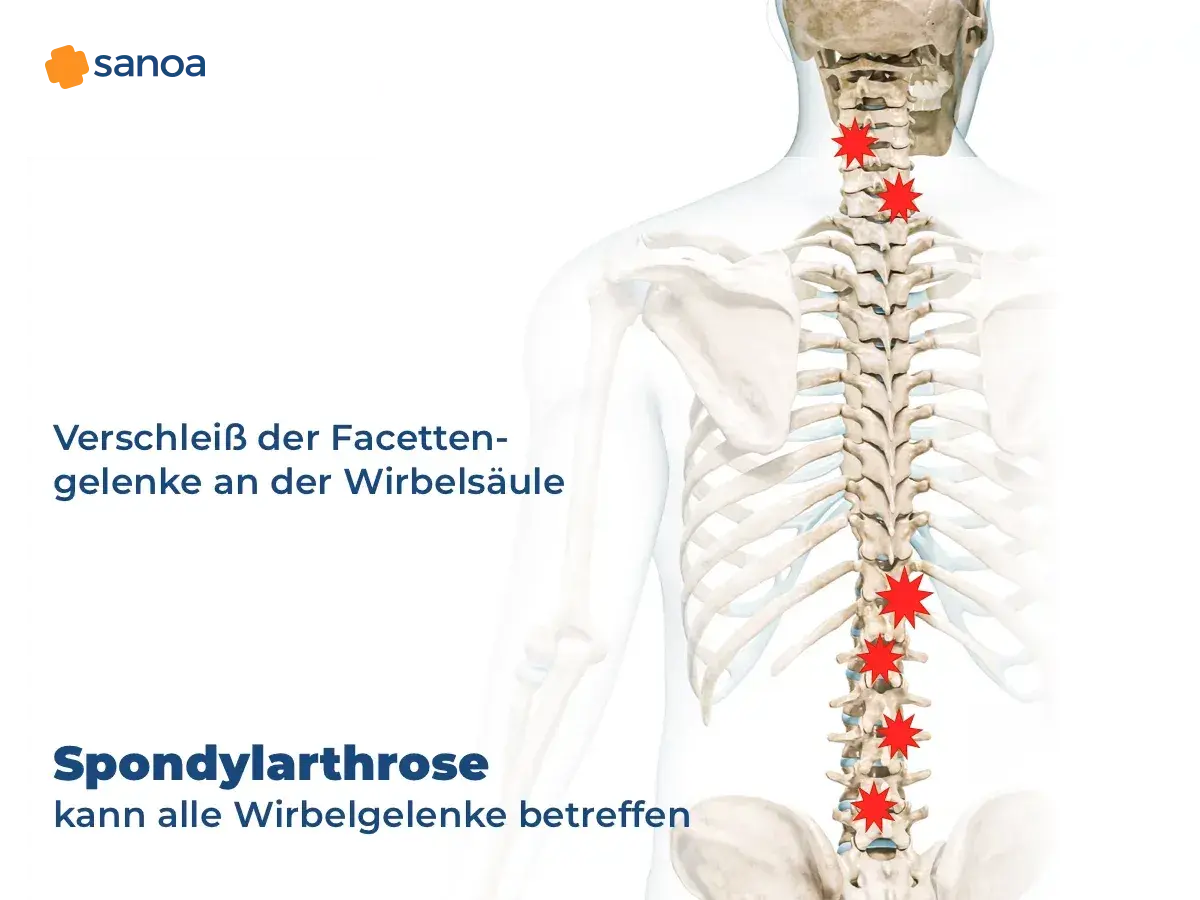 Spondylose mit Radikulopathie: Verschleiß der Facettengelenke an der Wirbelsäule, rot markierte Schmerzpunkte.