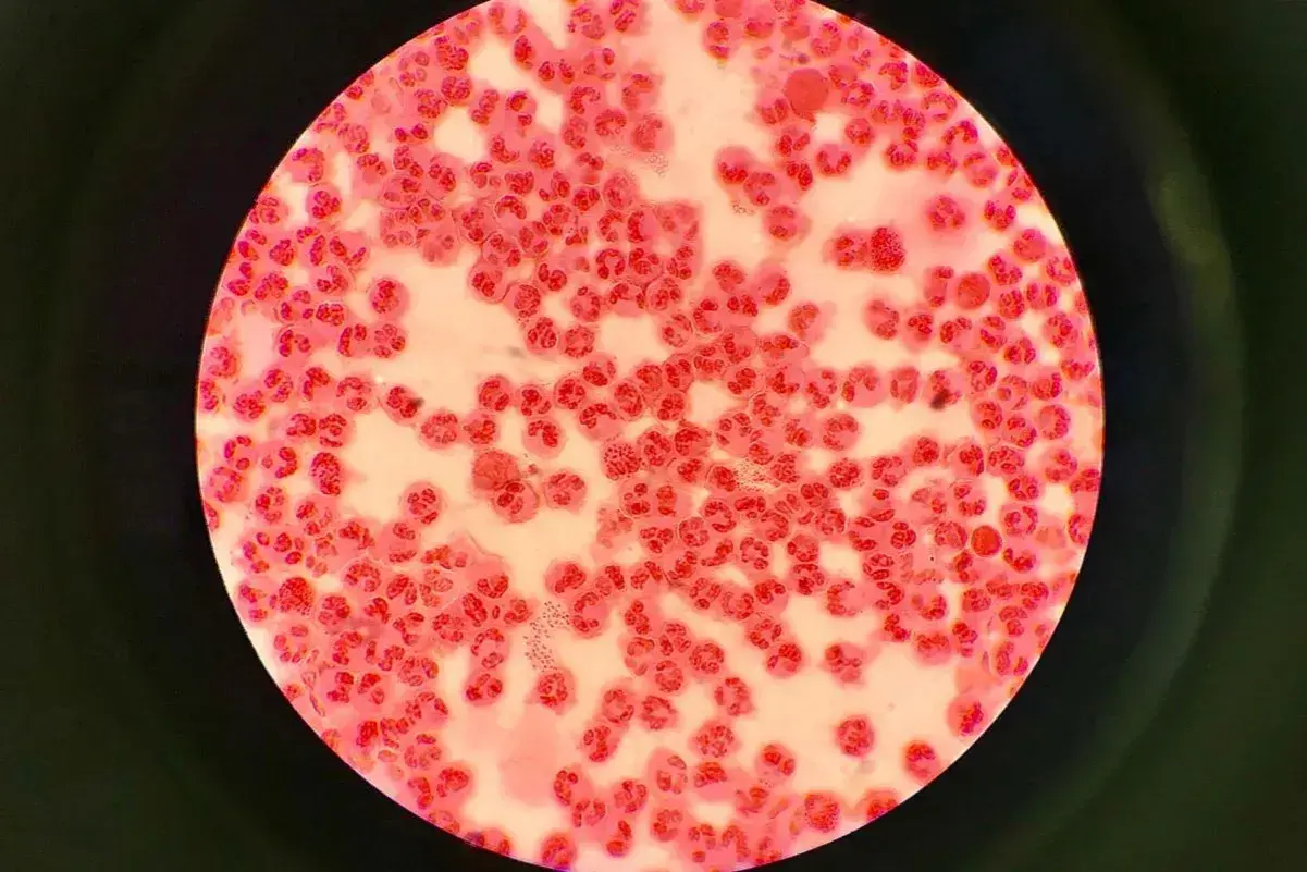 Mikroskopowy obraz komórek zapalnych i bakterii Neisseria gonorrhoeae, które mogą powodować rzeżączkę na penisie.