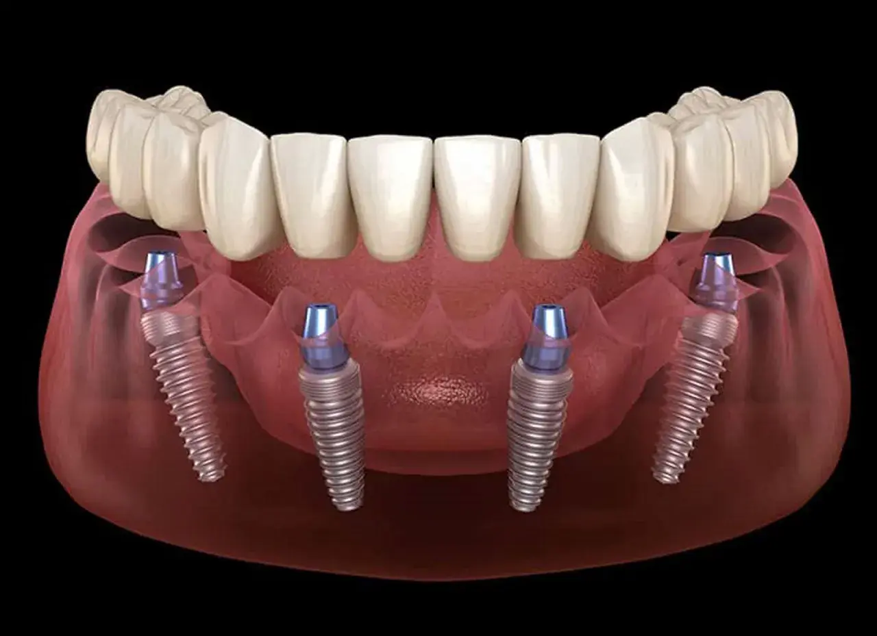 Immagine 3D di un'arcata dentale superiore con protesi fissa su quattro impianti, dimostrando la tecnica di implantologia all on four.