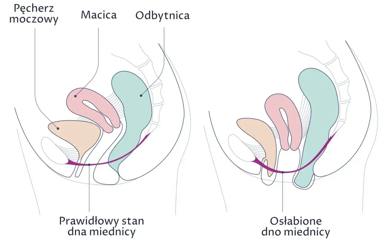 Porównanie prawidłowego i osłabionego dna miednicy. Na drugim obrazku widać obniżenie narządów, co może prowadzić do wypadania pochwy.