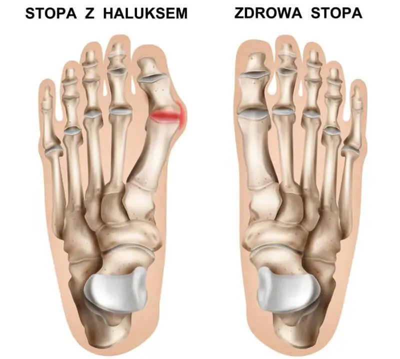 Jak powstają haluksy? Przyczyny, mechanizm i profilaktyka