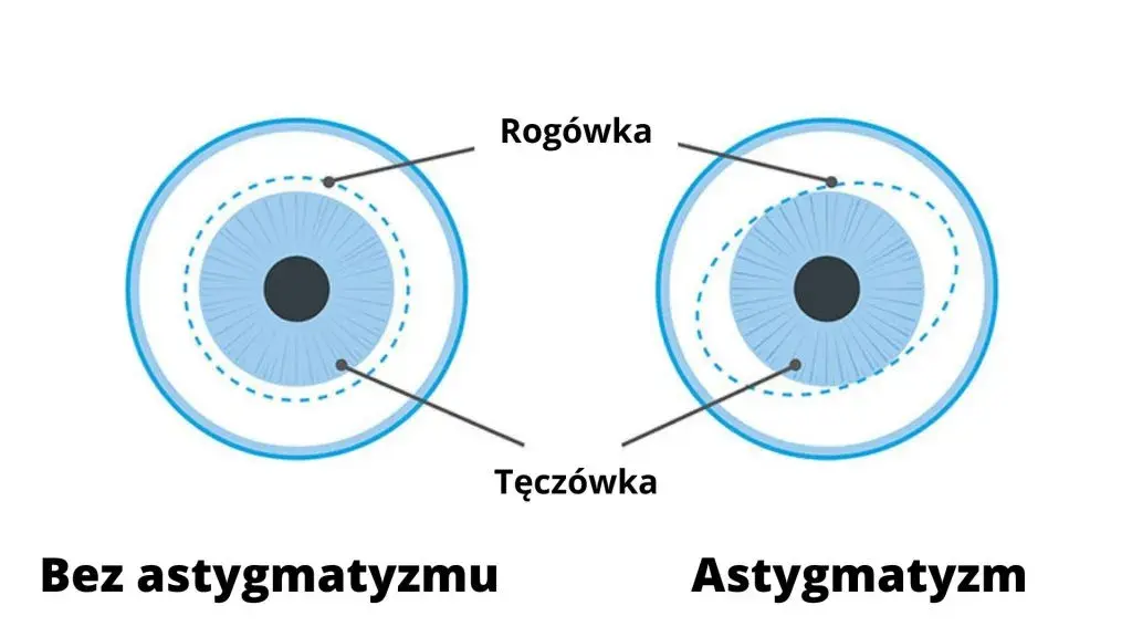 Astygmatyzm: Czy okulary są konieczne? Sprawdź, od czego zależy