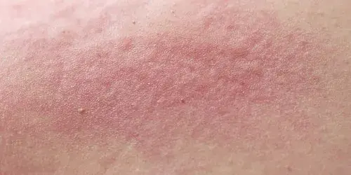 Czy Dermosan uczula? Sprawdź, jakie składniki mogą wywołać reakcje alergiczne