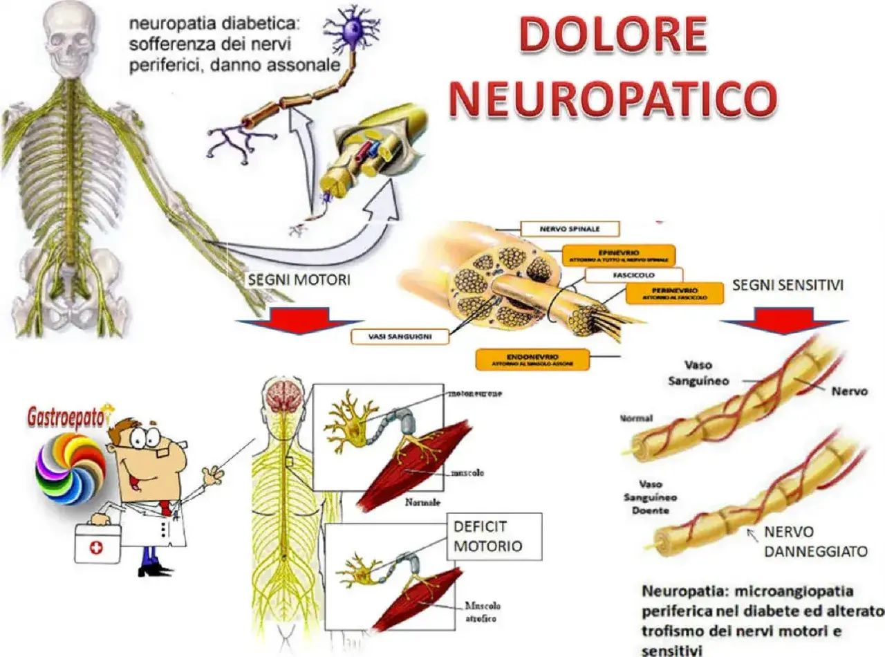 Il dolore neuropatico è illustrato con schemi di nervi, vasi sanguigni e muscoli, mostrando i danni da neuropatia diabetica.