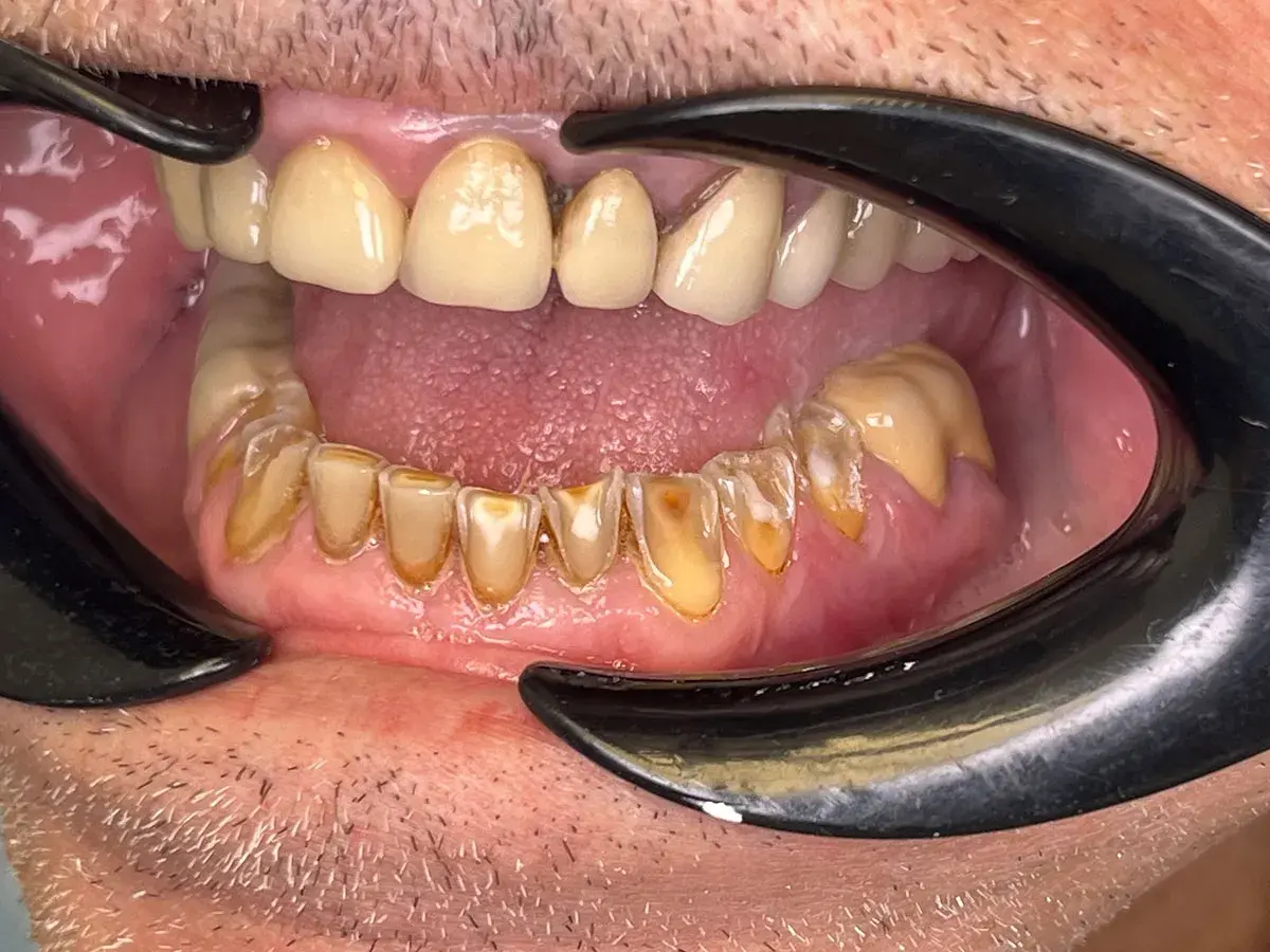 Boca abierta con dientes amarillentos y desgastados, mostrando signos de **abrasión dental**. Se aprecian restauraciones y encías inflamadas.
