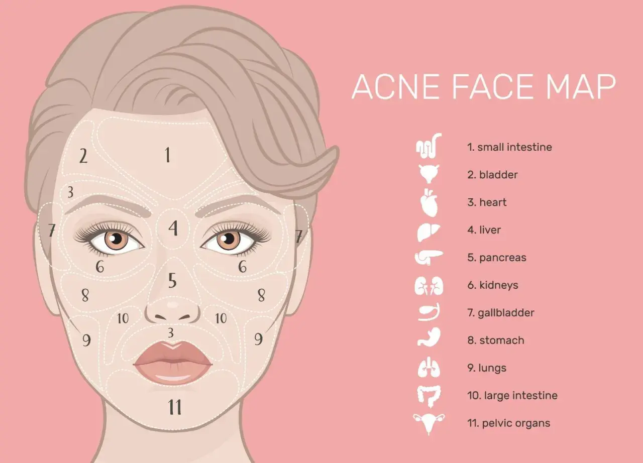 Mappa del viso per l'acne: i brufoli sulla mandibola (zona 9) potrebbero indicare problemi intestinali.