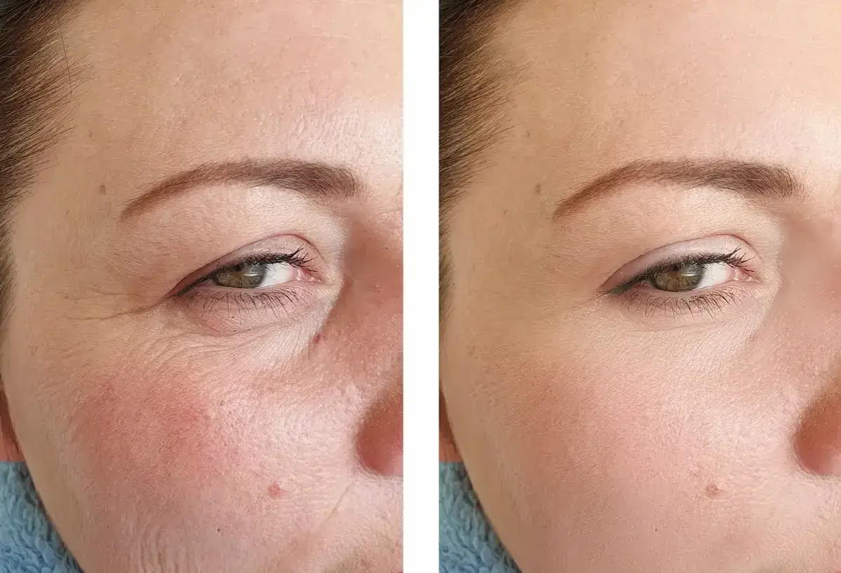 Comparaison avant/après : la peau ridée à gauche est lissée à droite, montrant l'efficacité du tretinoin vs retinol pour réduire les rides.
