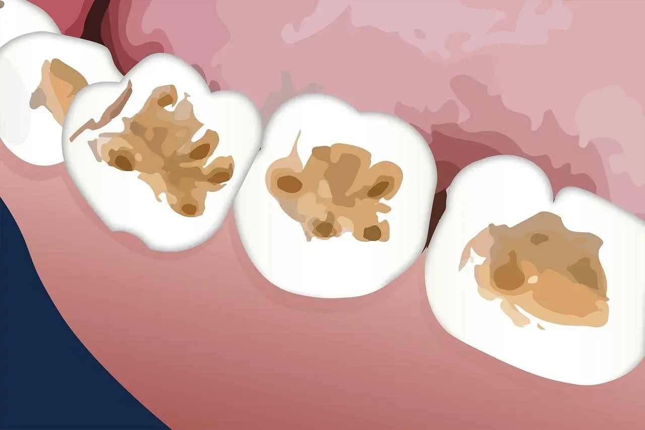 Dientes con cavidades marrones y oscuras, indicando caries en dentina.