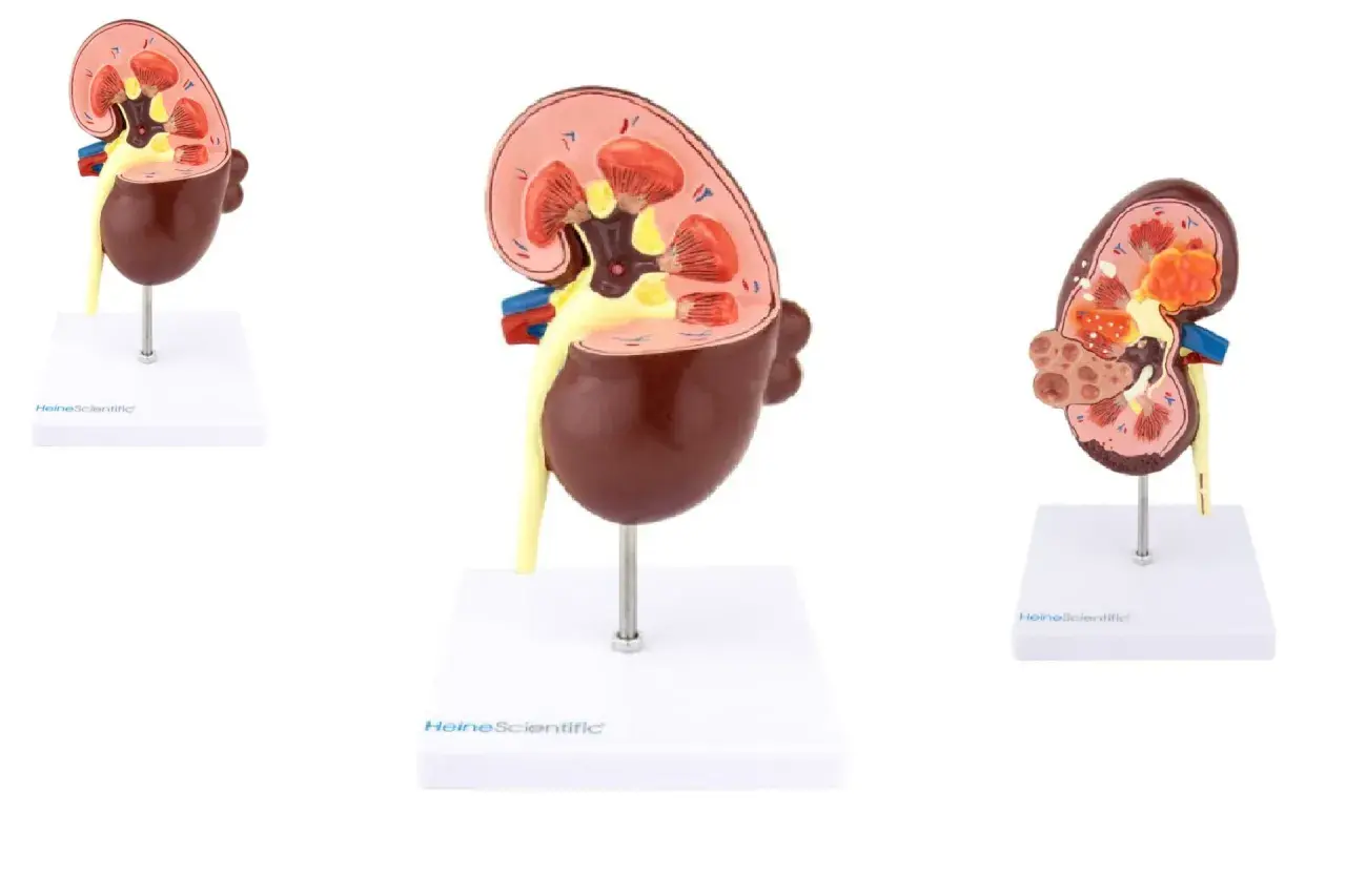 Modele nerek pokazują budowę, w tym kłębuszki nerkowe, oraz zmiany chorobowe, jak guzy.