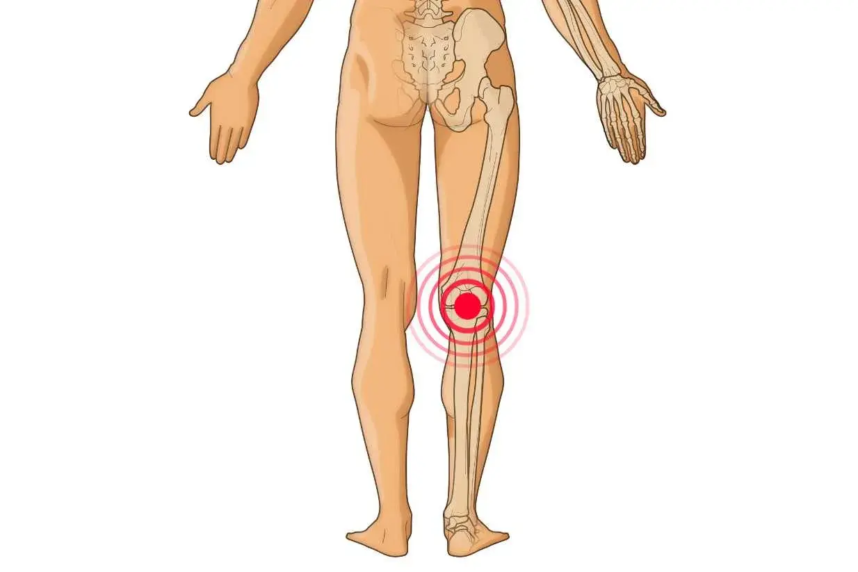 Röntgenbild des menschlichen Beins mit Fokus auf die Knieanatomie und Sehnen. Ein roter Kreis zeigt Schmerzen im Kniebereich an.