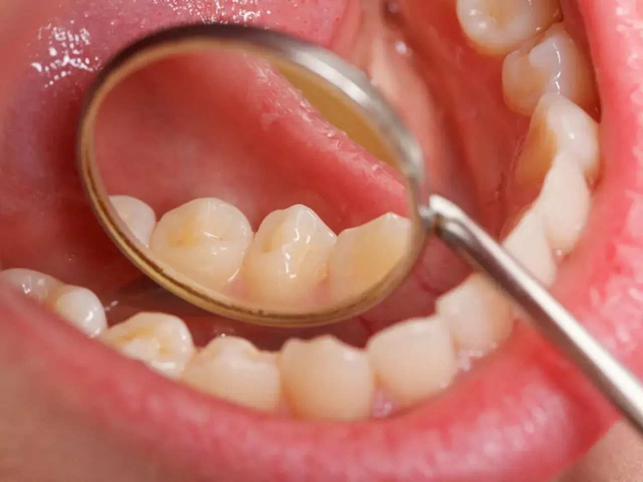 Widok jamy ustnej z lusterkiem dentystycznym. Widoczne zęby z przebarwieniami, które mogą świadczyć o tym, jak szybko rozwija się próchnica.