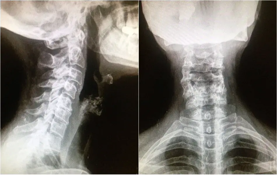 Síntomas de artrosis cervical grave: identifica el dolor y la debilidad