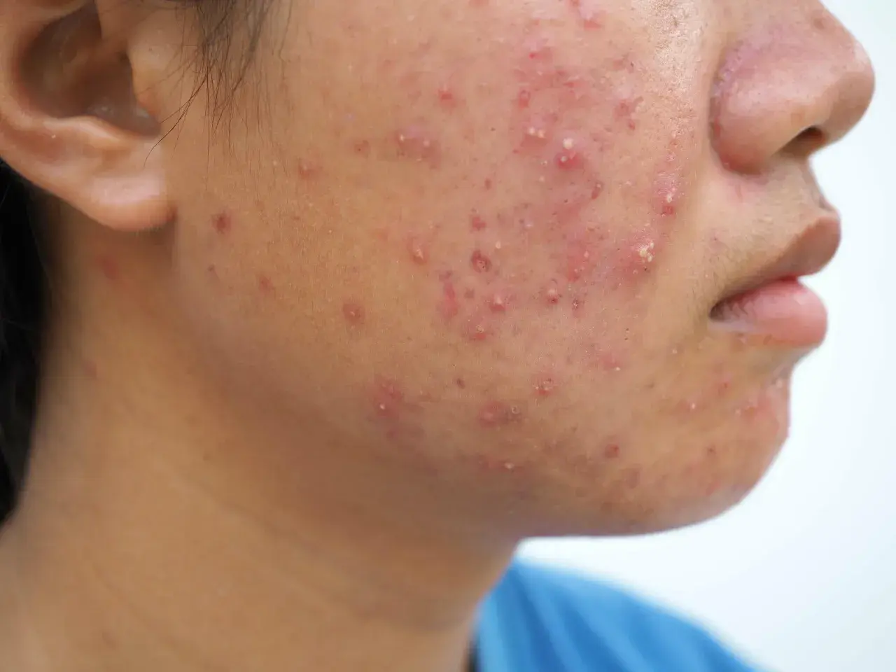 Primer plano de la mejilla de una persona con numerosos granos rojos e inflamados, algunos con pus, indicativos de acné fungico.