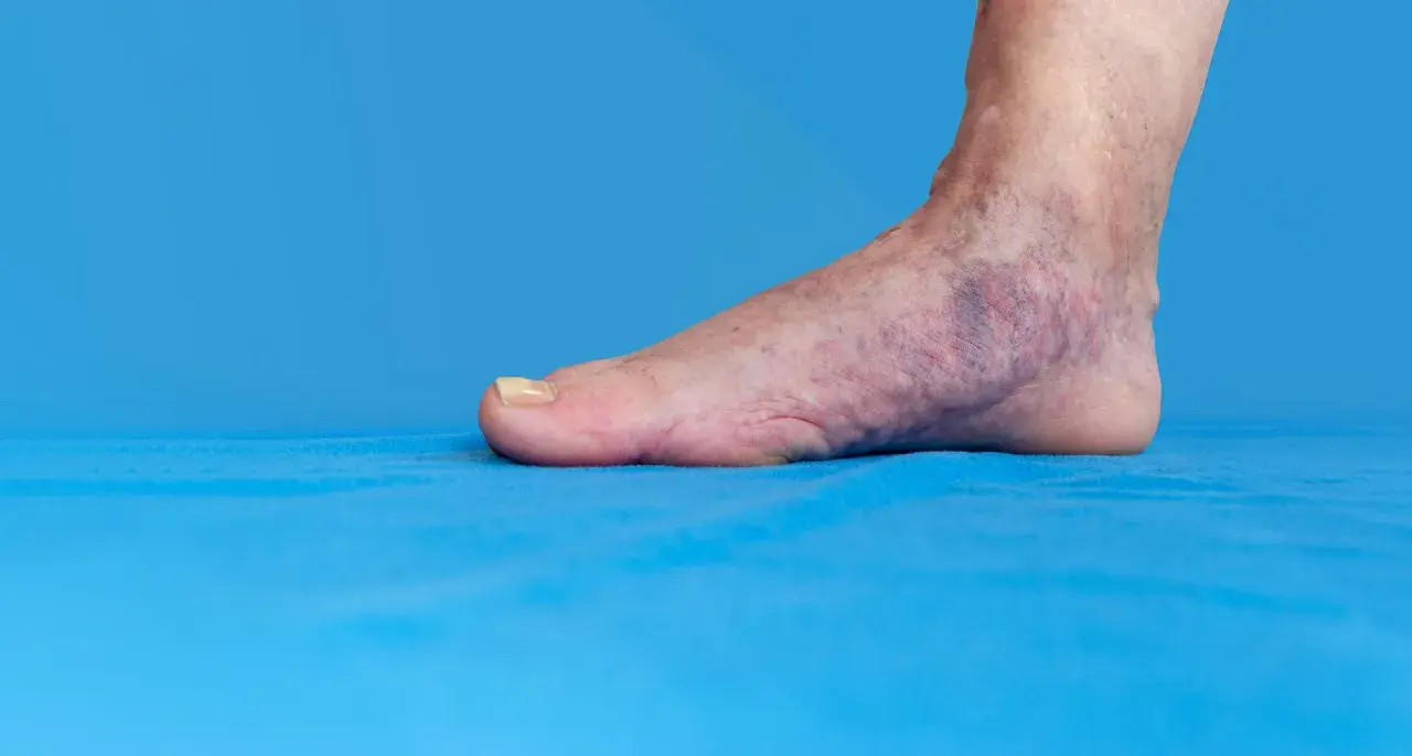 Fuß mit blauen Verfärbungen und sichtbaren Venen auf blauem Hintergrund.