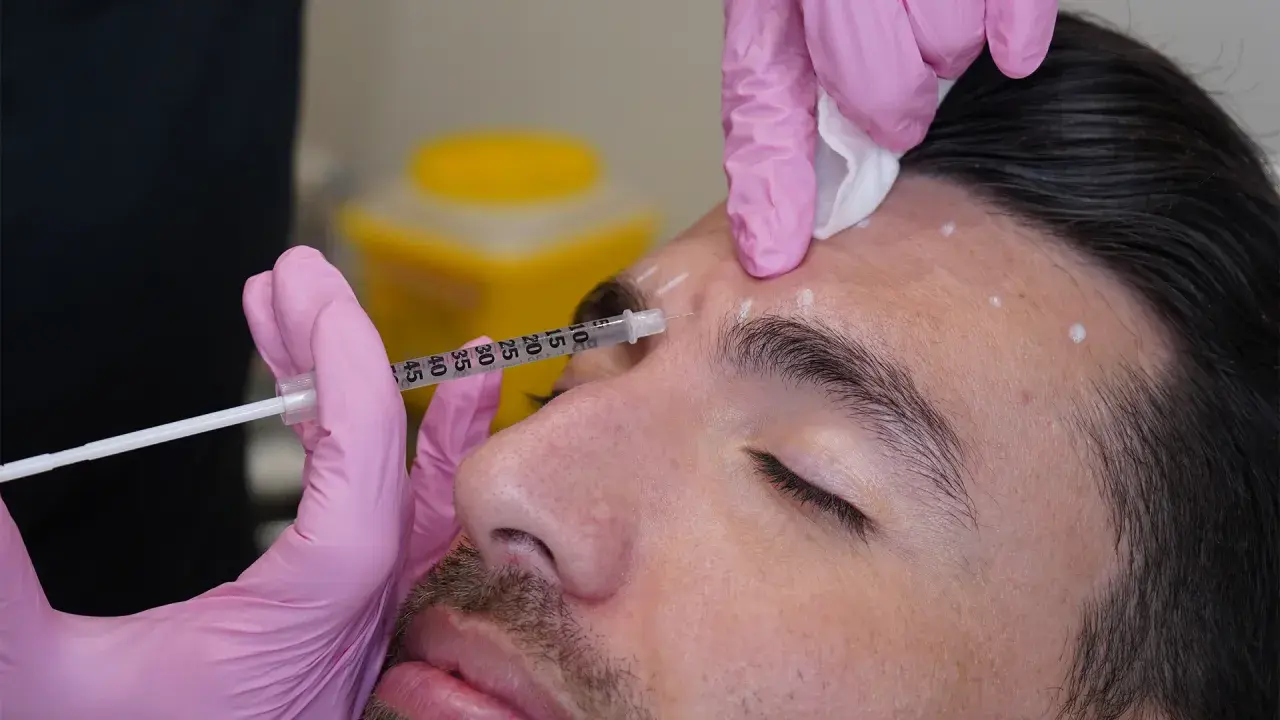 En person får medicinsk botox i pannan. Märkta punkter visar injektionsställen.