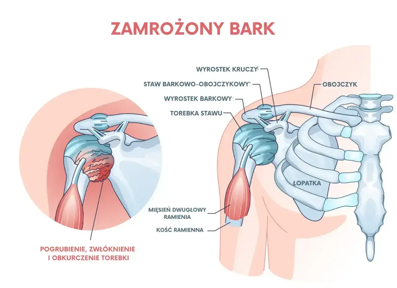 Ilustracja przedstawia zamrożony bark, z zaznaczonym pogrubieniem i zwłóknieniem torebki stawu, co powoduje ból barku.