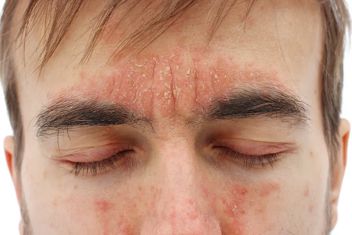 Rote, schuppige Haut im Gesicht, die auf Dermatitis hindeutet. Suche nach Dermatitis Hausmittel zur Linderung.