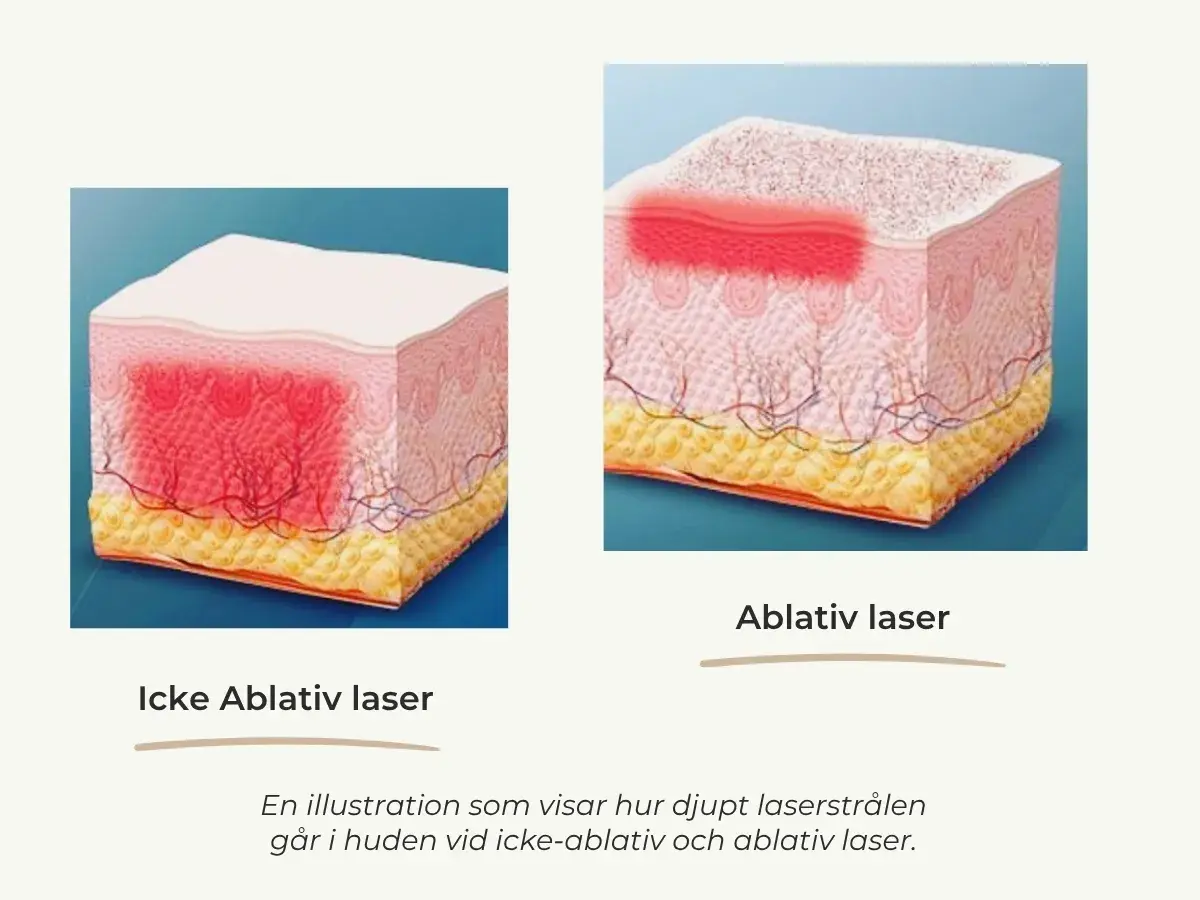 Illustrationer visar hur en co2 laser påverkar huden. Icke-ablativ laser värmer djupare, ablativ laser avlägsnar ytskiktet.