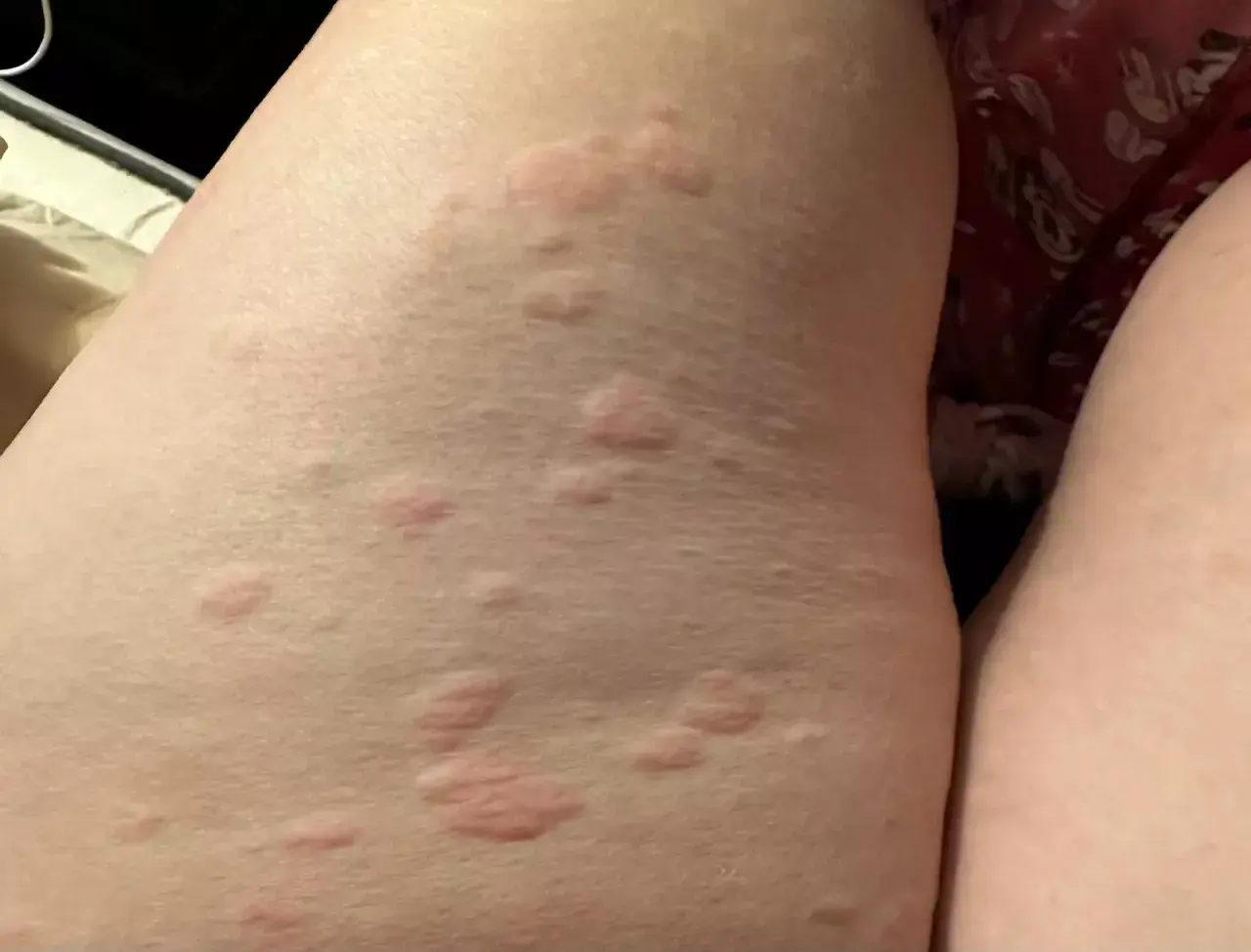Eruzione cutanea con pomfi rossi e pruriginosi sulla pelle, possibile orticaria parainfettiva.